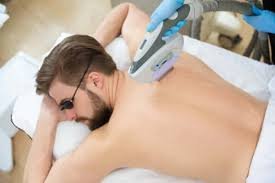 Male-Full-body-laser-treatment