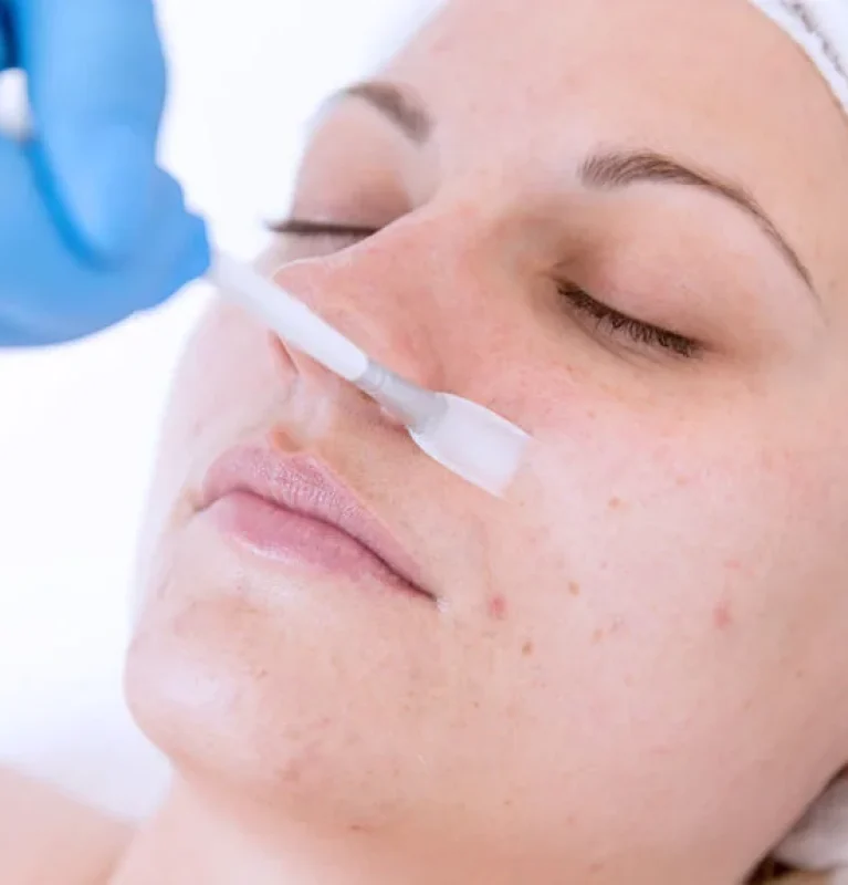 Facial peels at Kallos Aesthetics -treatment