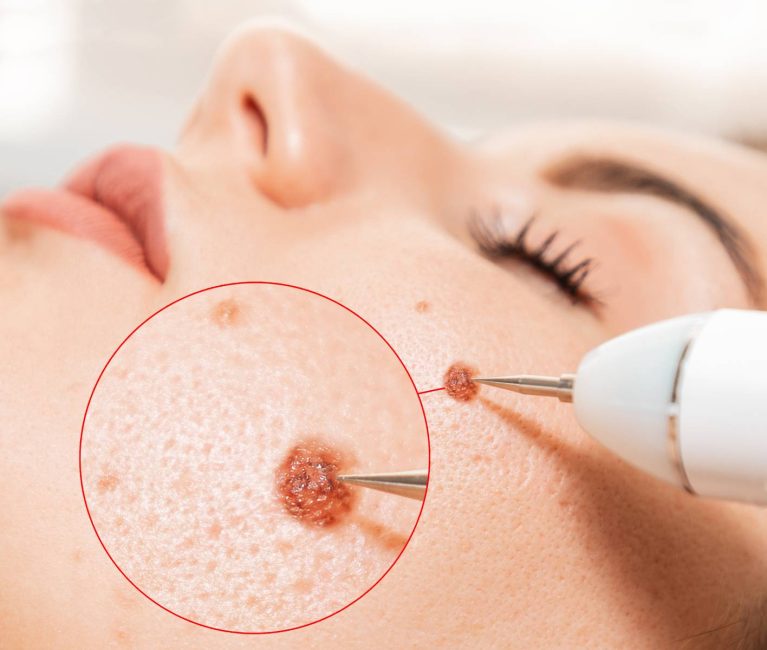 Moles and Warts removal treatment Moles and Warts removal treatment
