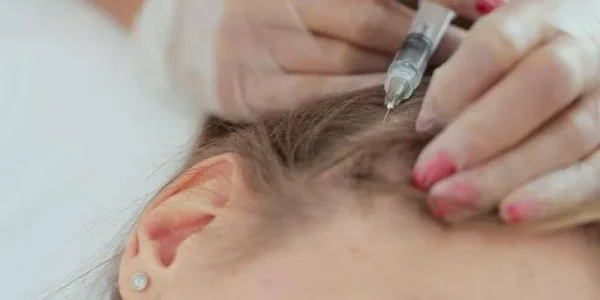 Exosomes-hair-loss-therapy Exosomes-hair-loss-therapy