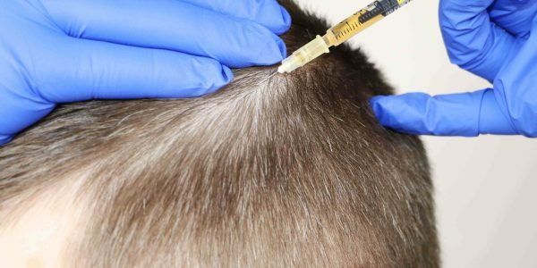 PRP-Hair-Treatment