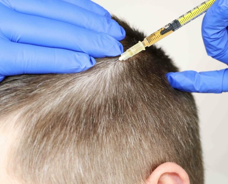 PRP-Hair-Treatment