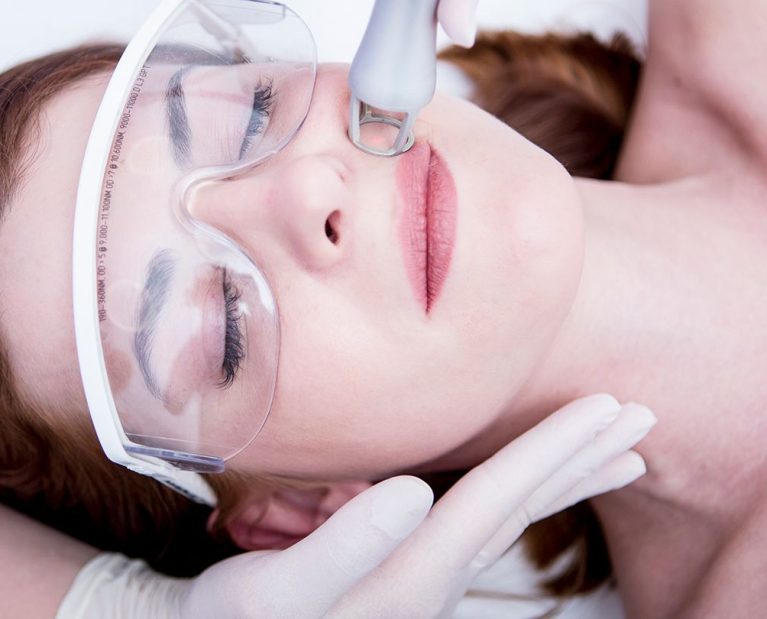 LASER, treatment at Kallos Aesthetics,. LASER, treatment at Kallos Aesthetics,.