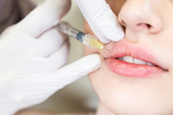 Lip Flip in Multan, Subtle Volume Without Fillers Botox Lip Flip treatment in Multan for a fuller upper lip